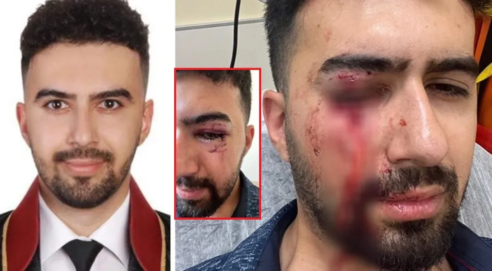 Avukata Saldırı: Yüzüne 14 Dikiş Atıldı, 4 Kişi Suçu Üstlenmek İstedi