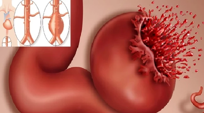Aort Yırtığı Nedir? Belirtileri, Tedavisi ve Süreçleri